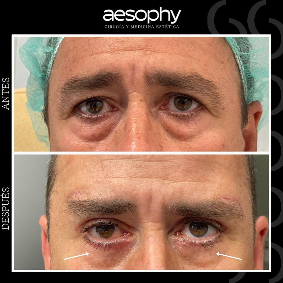 Blefaroplastia en Málaga: Rejuvenece tu Mirada en Clínica Aesophy