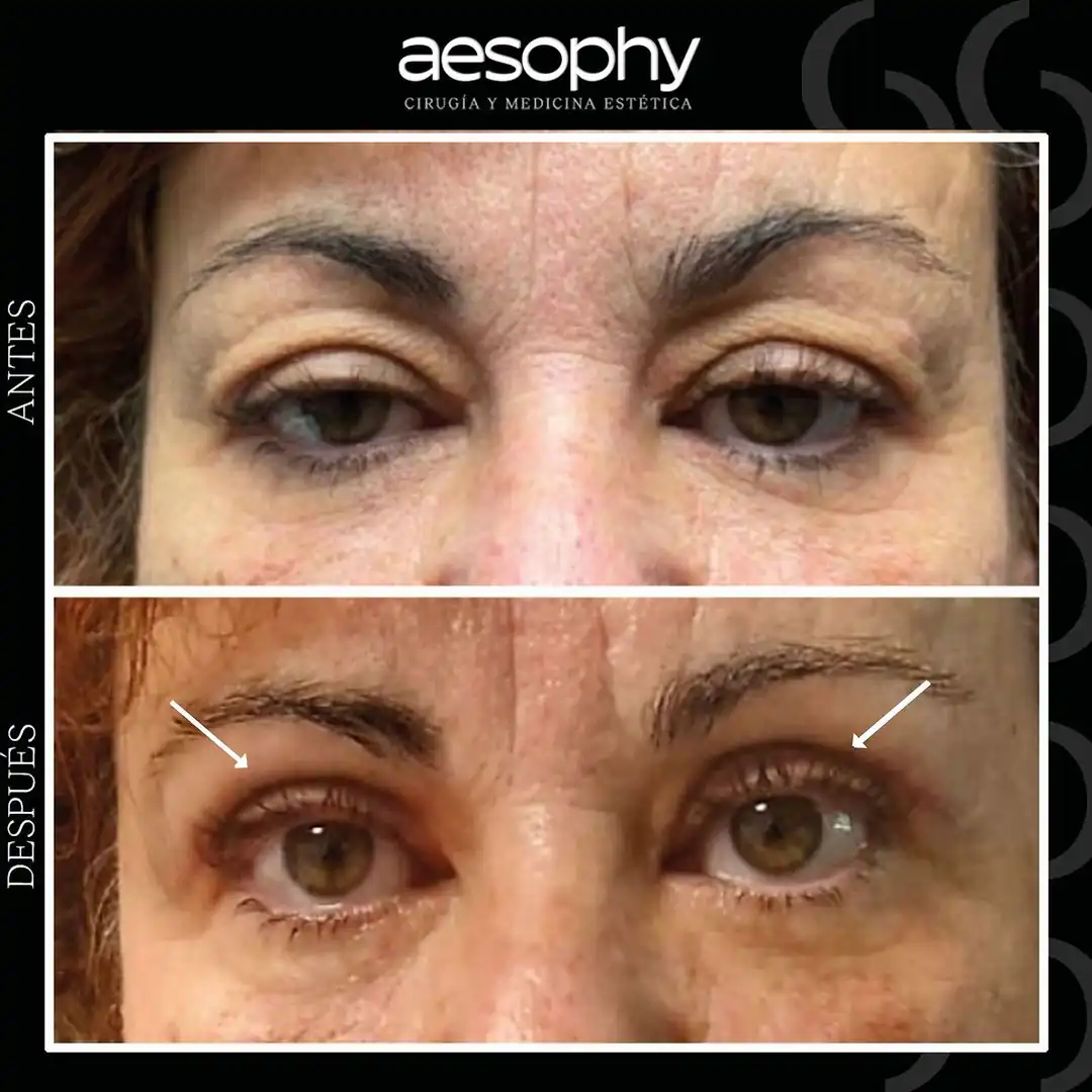 Blefaroplastia en Málaga: Rejuvenece tu Mirada en Clínica Aesophy