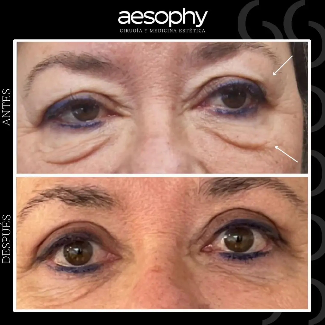 Blefaroplastia en Málaga: Rejuvenece tu Mirada en Clínica Aesophy